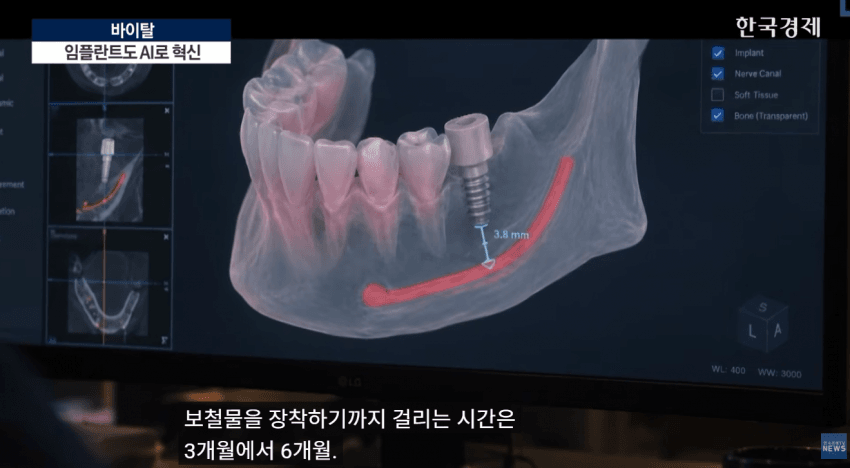 임플란트도 AI가 대세…수술 하루 만에 끝낸다 (7)