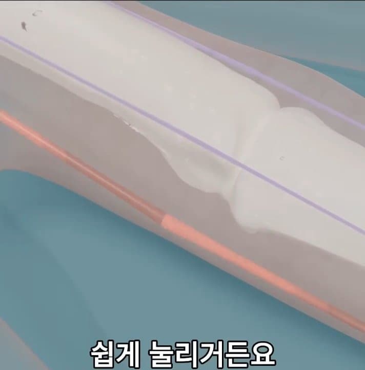 싱글벙글 손가락이 잘렸을 때 대처법 (39)