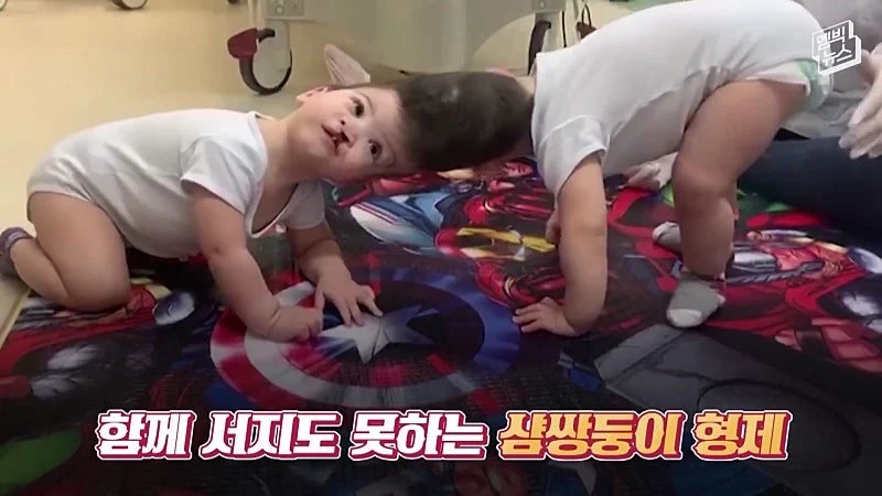 33시간 수술 끝에 얼굴 본 쌍둥이 (6)