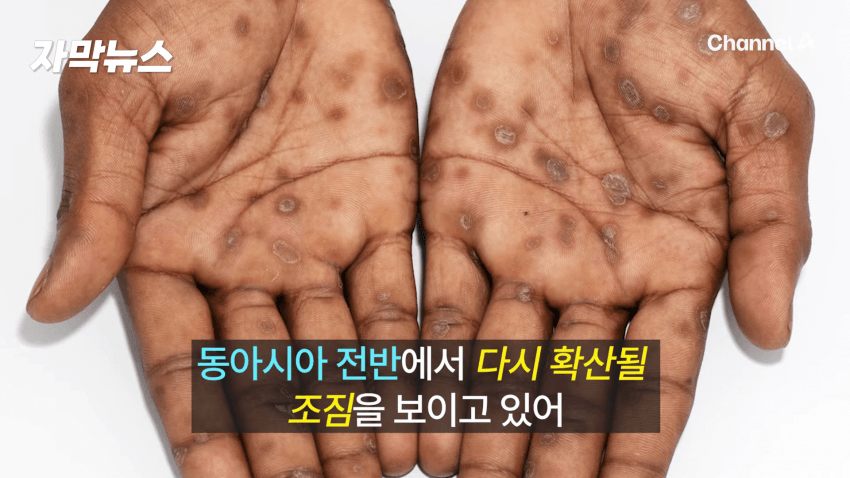 매독 감염자 확산, 한국 2030 남성 상당수(?) (2)