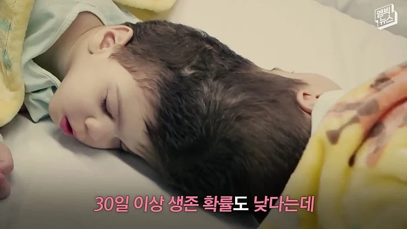 33시간 수술 끝에 얼굴 본 쌍둥이 (31)