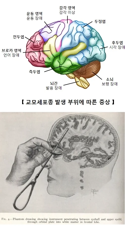 인류가 알고 있는 유일한 조현병 완치법 (2)