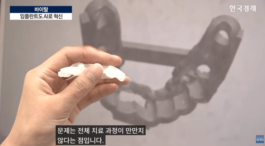 임플란트도 AI가 대세…수술 하루 만에 끝낸다 (3)