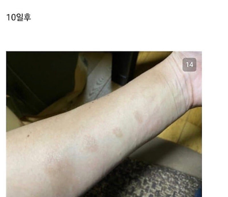 붉은사슴뿔버섯을 본인 몸에 실험한 일본인 (12)