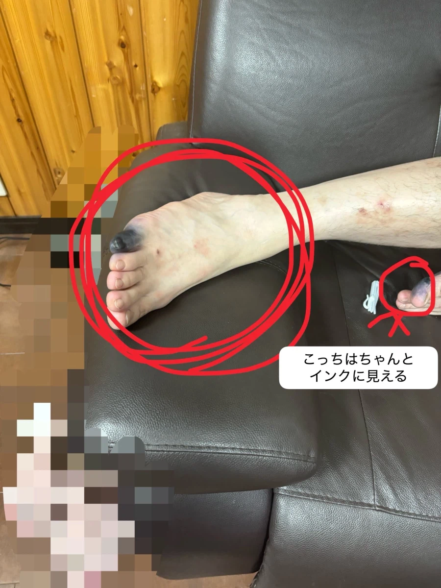 약혐)당뇨 걸려서 괴사한 새끼발가락...