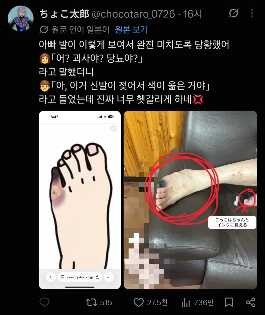 약혐)당뇨 걸려서 괴사한 새끼발가락... (2)