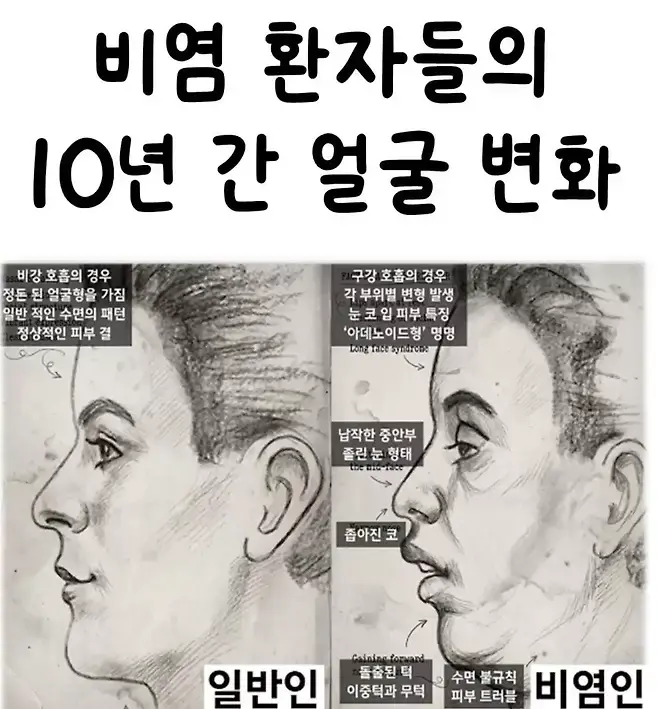 비염 환자들의 10년 간 얼굴 변화 (2)