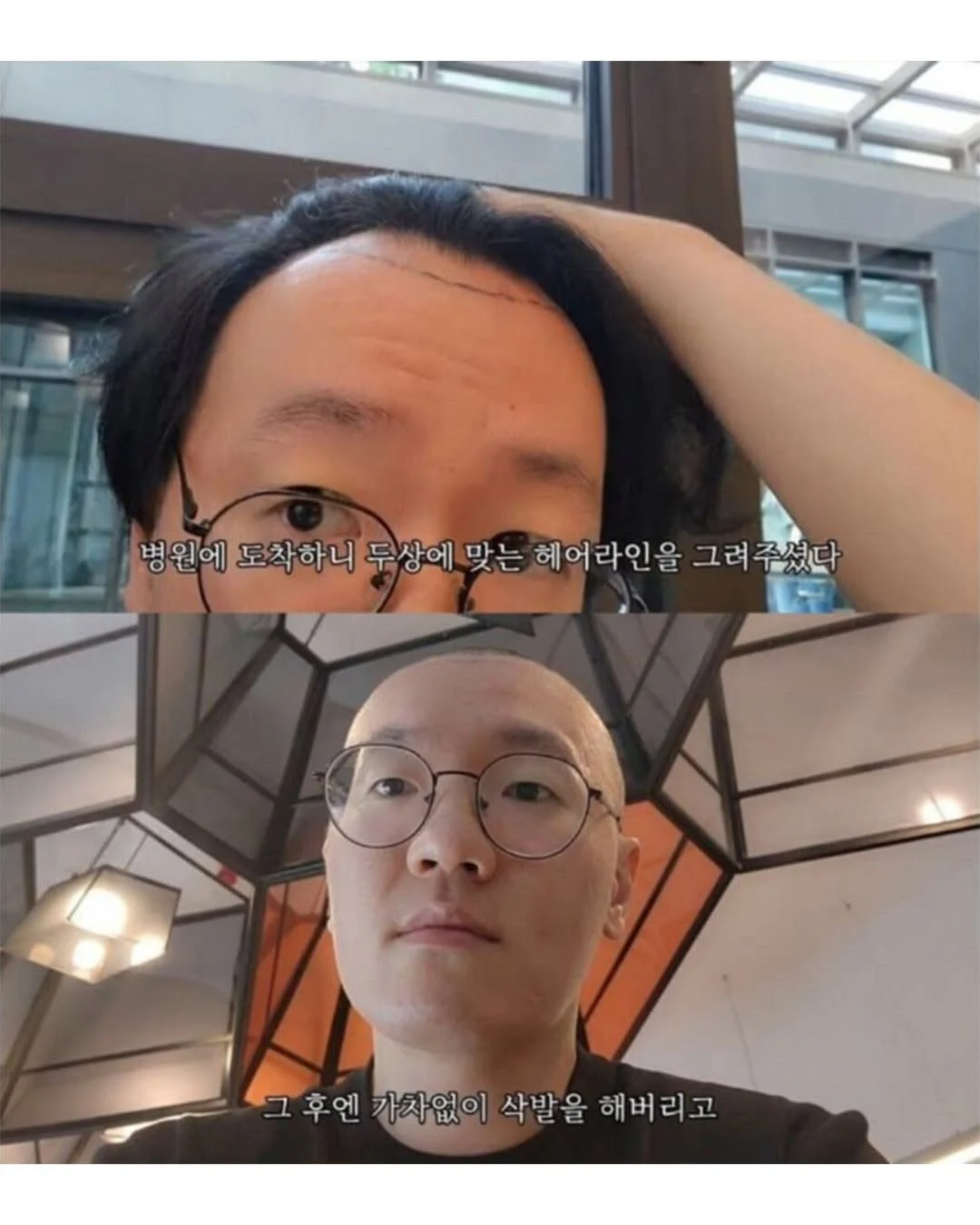 터키로 모발이식 받으러간 남자의 최후 (2)