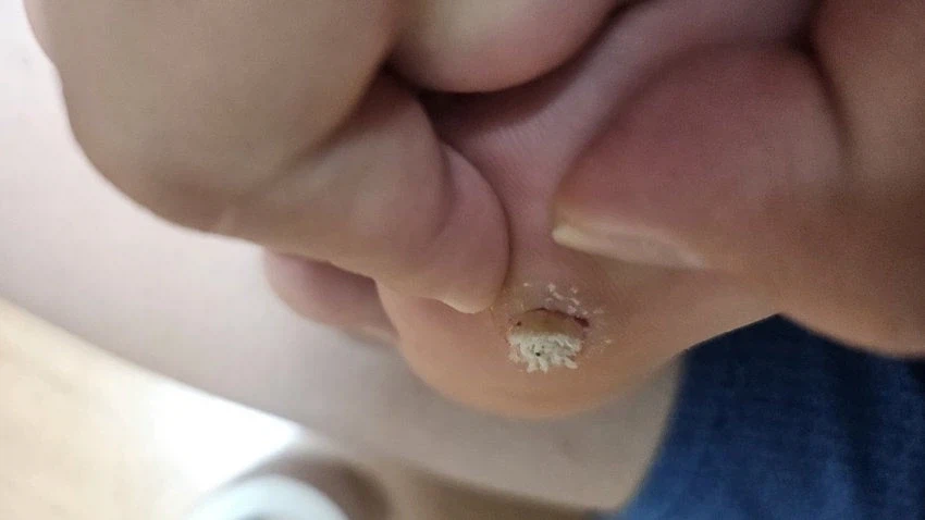 (혐) 사마귀를 통째로 뽑은 놈