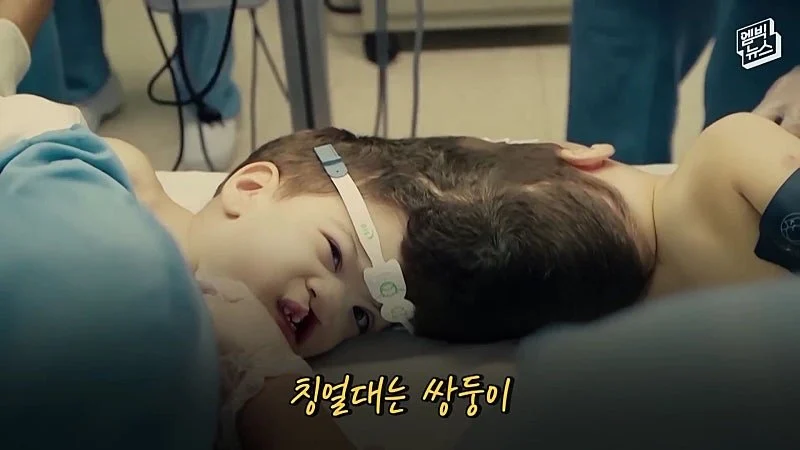 33시간 수술 끝에 얼굴 본 쌍둥이 (10)