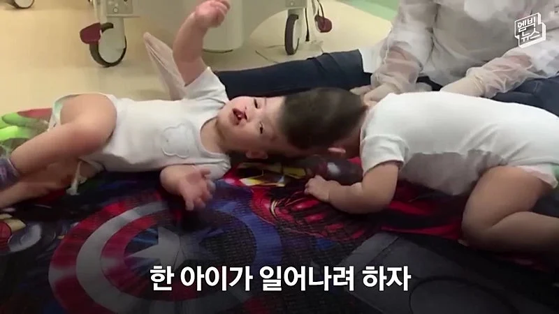 33시간 수술 끝에 얼굴 본 쌍둥이 (3)