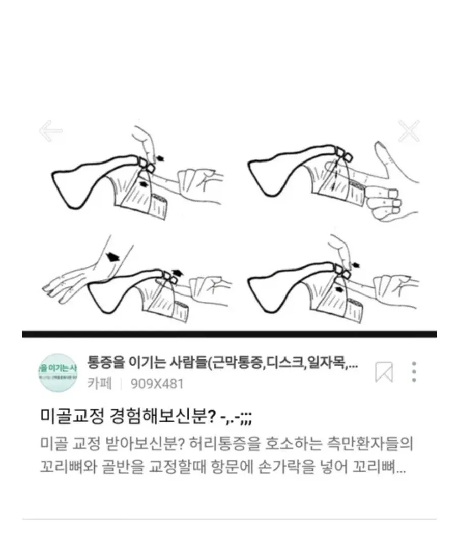항문에 직접손을 넣어 척추교정하는 미골교정.jpg