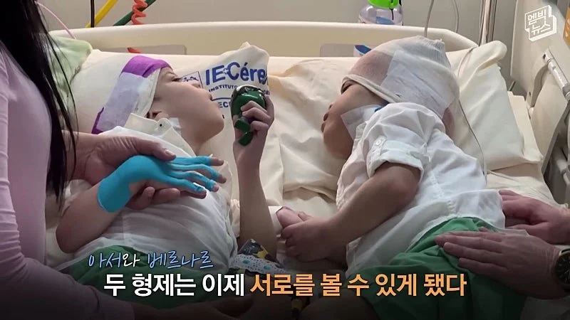33시간 수술 끝에 얼굴 본 쌍둥이 (29)