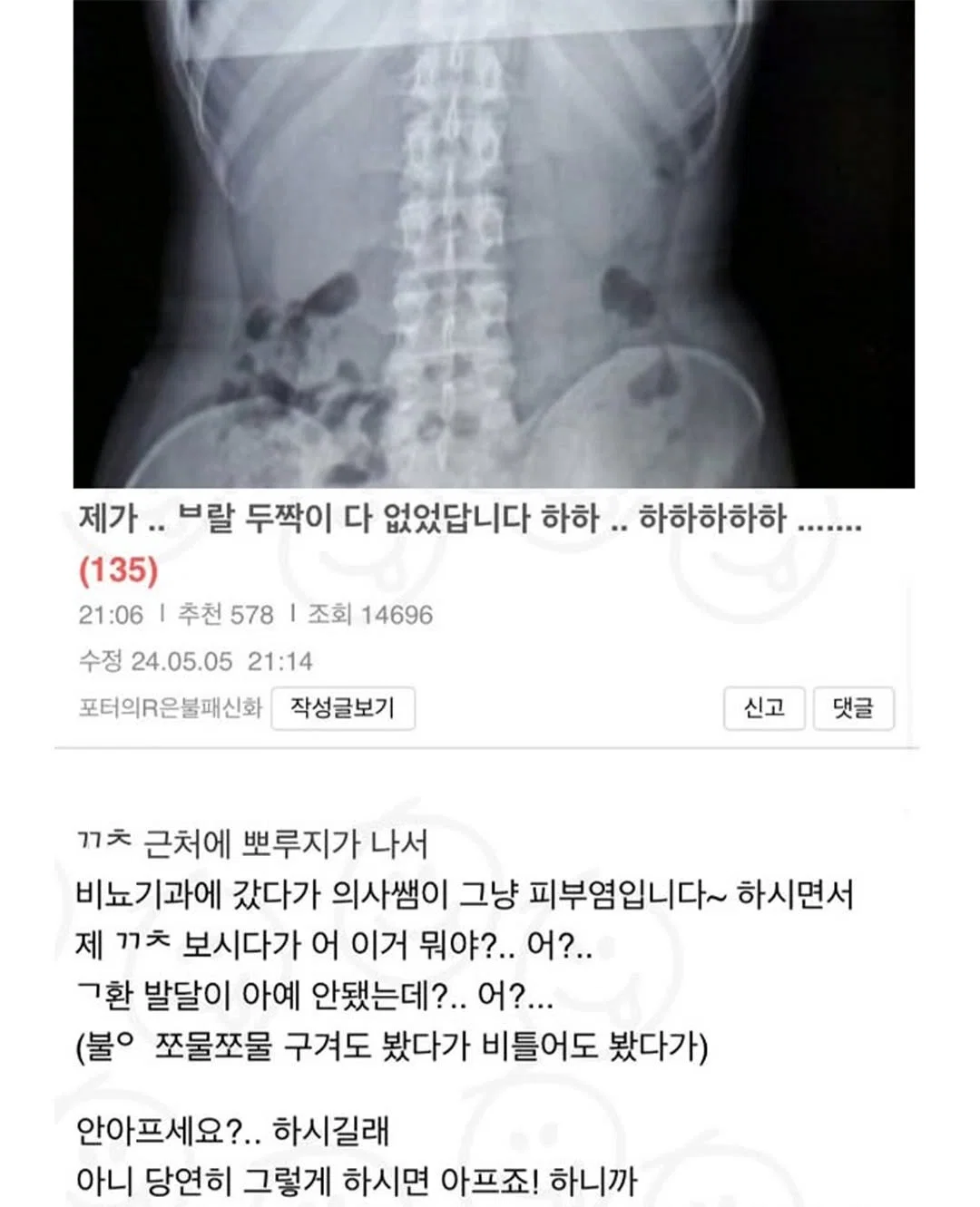 제가 부랄 두짝이 다 없었답니다..