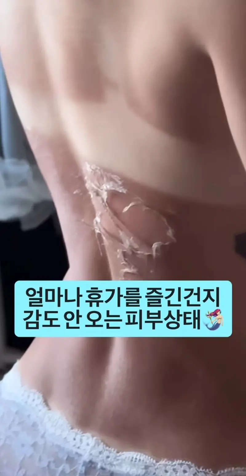 ㅇㅎ) 휴가 갔다 온 츠자의 피부 상태. (3)