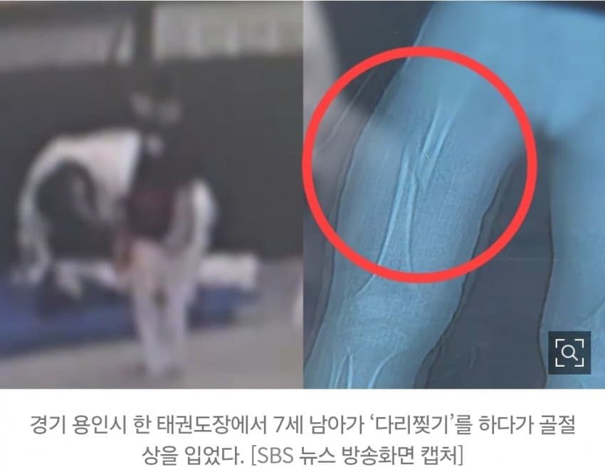 강제로 다리찢기 하다 허벅지뼈 부러진 7세…태권도장 아동학대 논란 (2)