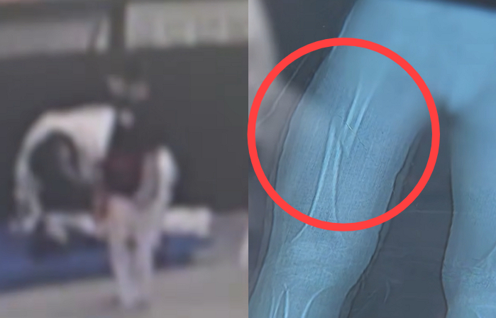 강제로 다리찢기 하다 허벅지뼈 부러진 7세…태권도장 아동학대 논란 (5)