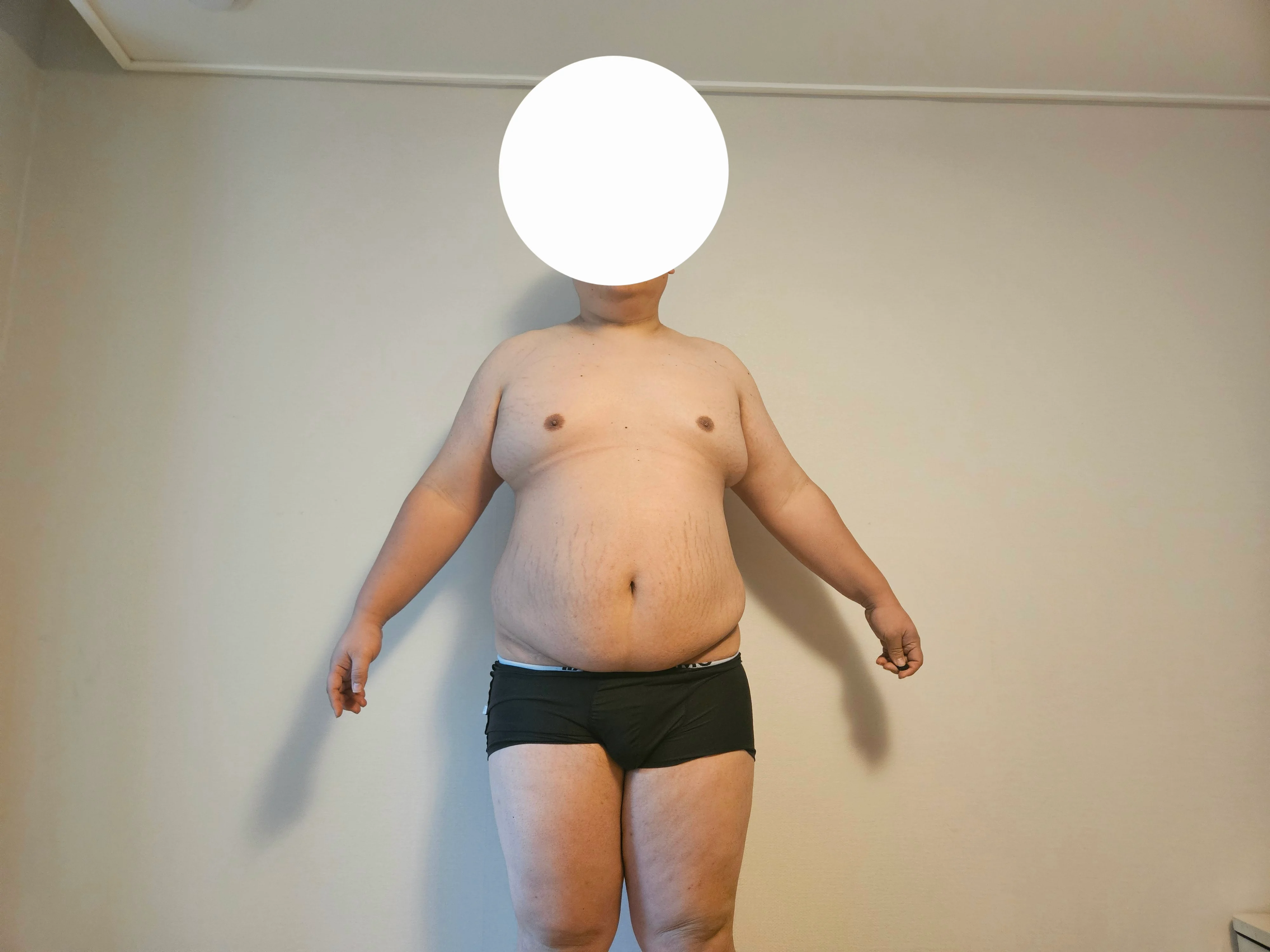 고도비만은 그냥 위고비 마운자로 맞아라