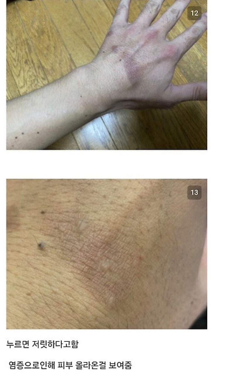 붉은사슴뿔버섯을 본인 몸에 실험한 일본인 (11)