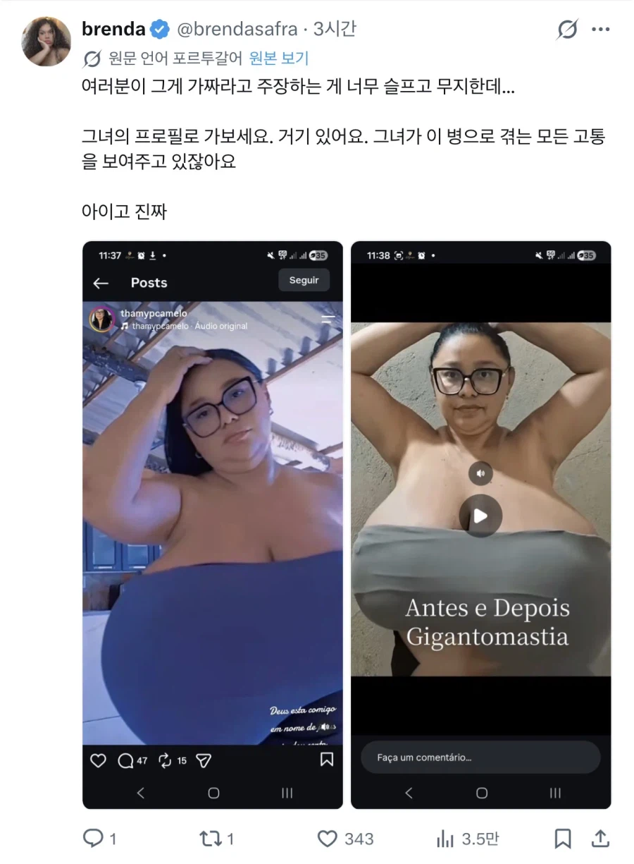 거대유방증을 앓은 여성의 수술 비포 애프터