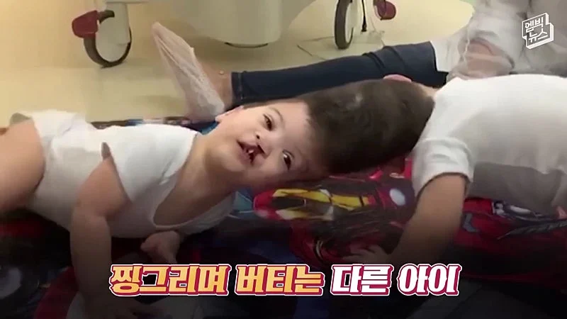 33시간 수술 끝에 얼굴 본 쌍둥이 (4)