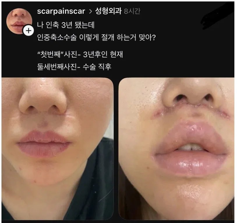 인중 축소 3년차인데 이렇게 절개하는 게 맞아?