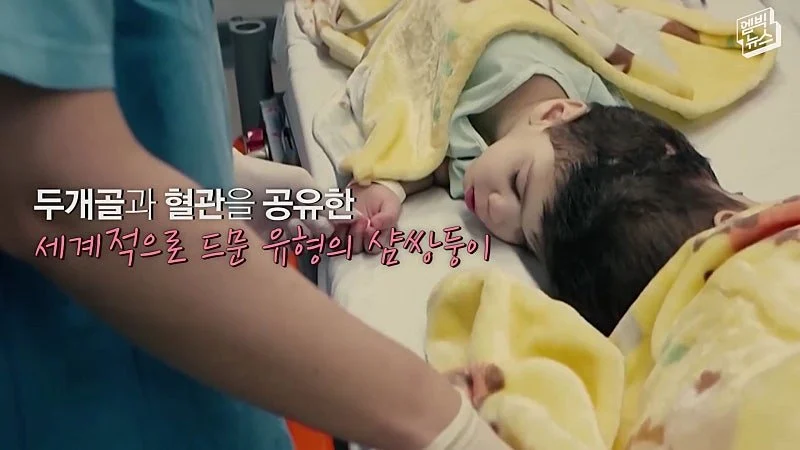 33시간 수술 끝에 얼굴 본 쌍둥이 (30)