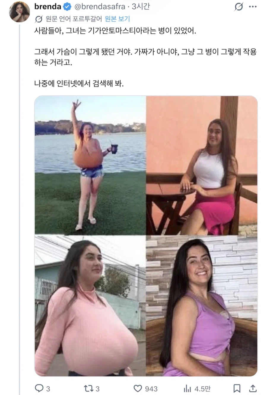거대유방증을 앓은 여성의 수술 비포 애프터 (2)