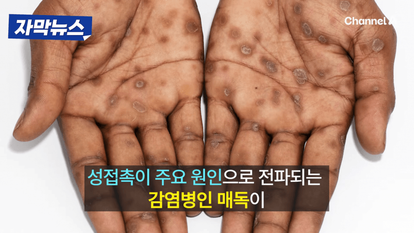 매독 감염자 확산, 한국 2030 남성 상당수(?)