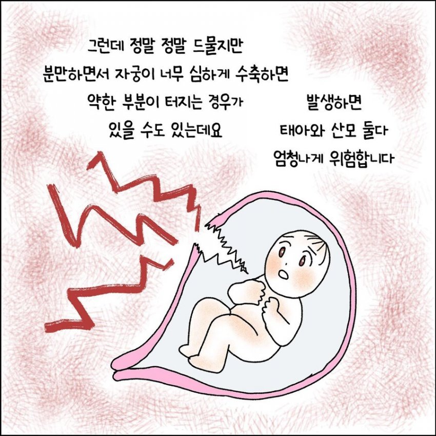 오싹오싹 산부인과에서 출산 중 자궁파열된 썰 (3)