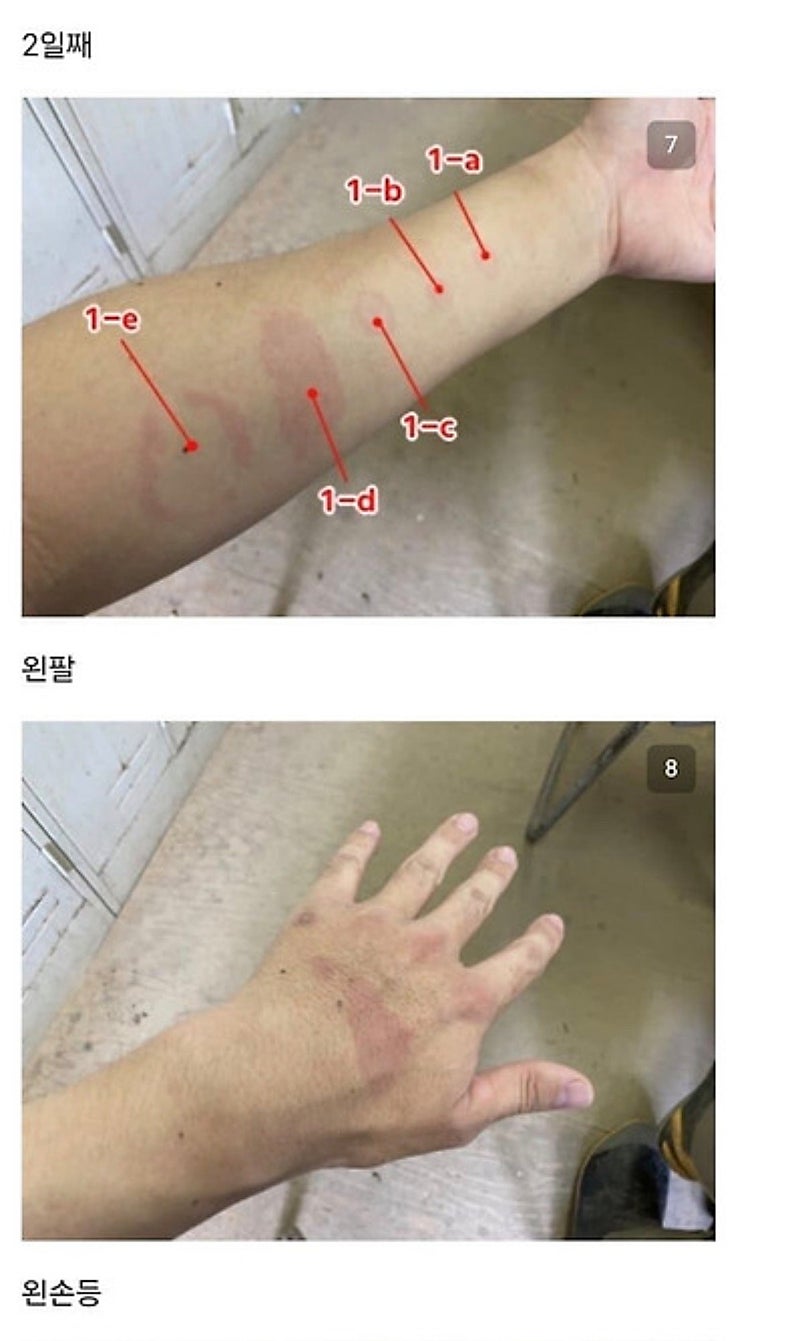 붉은사슴뿔버섯을 본인 몸에 실험한 일본인 (8)