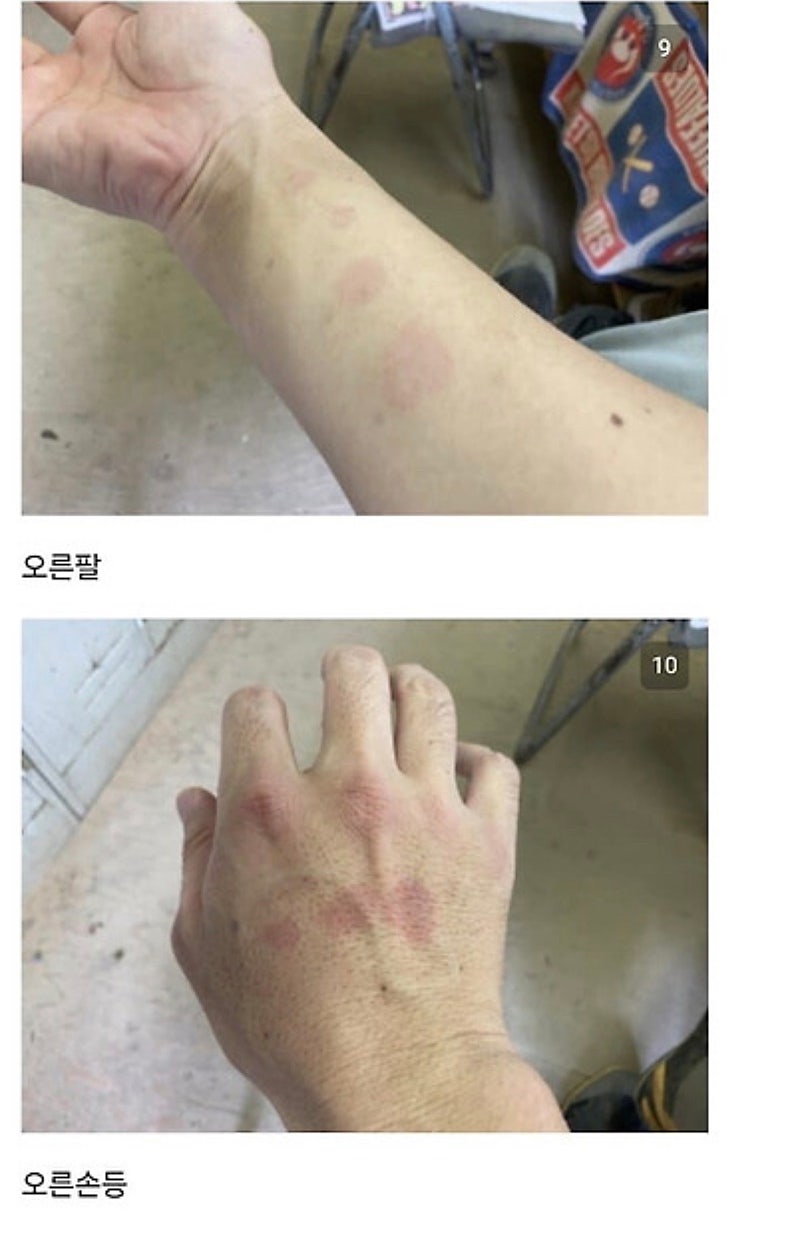 붉은사슴뿔버섯을 본인 몸에 실험한 일본인 (9)
