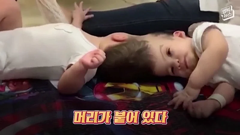33시간 수술 끝에 얼굴 본 쌍둥이 (2)