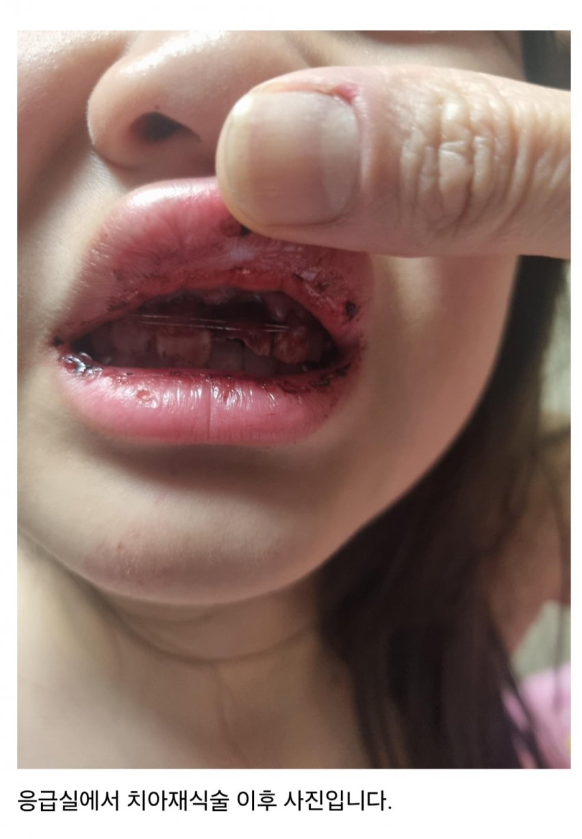 혐주의) 으악으악 외국인이 여자아이 치고 뺑소니 쳐 치아 파손 (3)