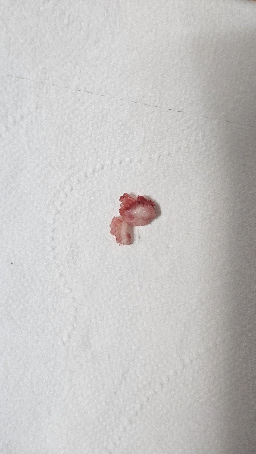 (혐) 사마귀를 통째로 뽑은 놈 (3)