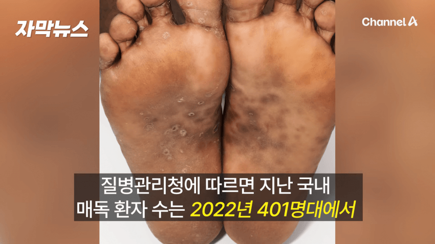 매독 감염자 확산, 한국 2030 남성 상당수(?) (4)
