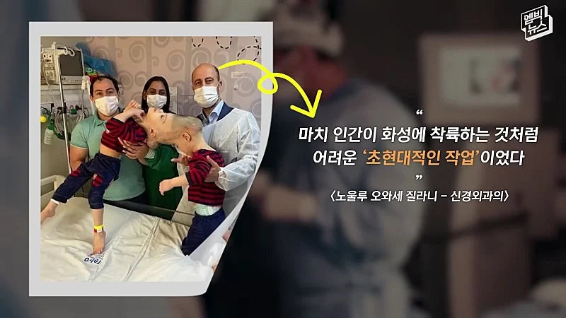 33시간 수술 끝에 얼굴 본 쌍둥이 (40)