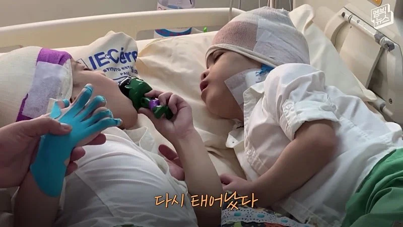 33시간 수술 끝에 얼굴 본 쌍둥이 (33)