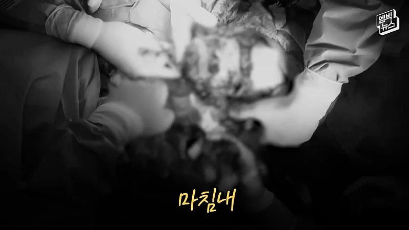 33시간 수술 끝에 얼굴 본 쌍둥이 (21)