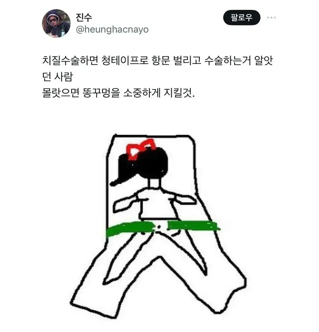 치질 수술할때 해야 한다는 자세 (2)