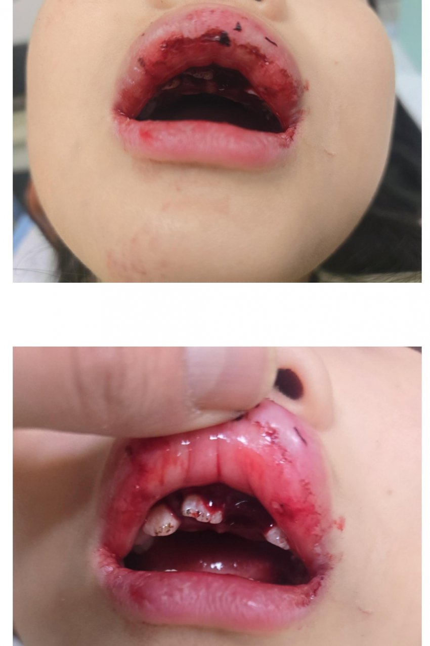 혐주의) 으악으악 외국인이 여자아이 치고 뺑소니 쳐 치아 파손 (2)