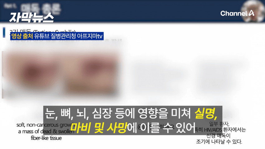 매독 감염자 확산, 한국 2030 남성 상당수(?) (17)