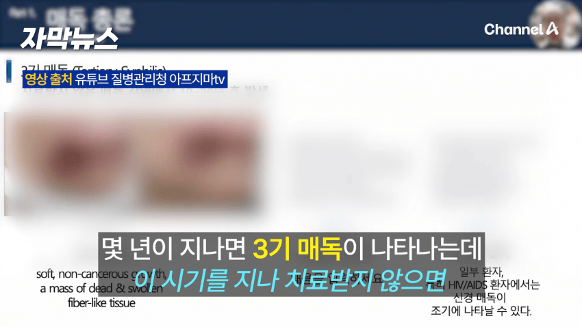 매독 감염자 확산, 한국 2030 남성 상당수(?) (16)