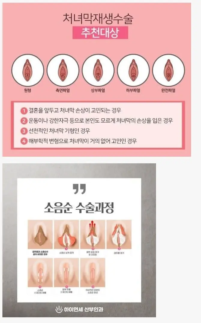 19) 젊은 여성들 사이에서 은근 인기 있는 수술. (2)