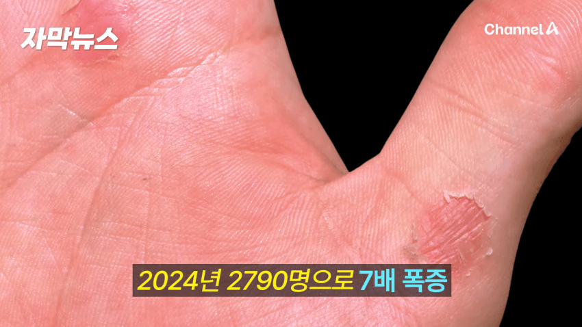 매독 감염자 확산, 한국 2030 남성 상당수(?) (5)