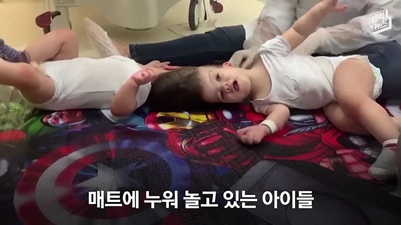 33시간 수술 끝에 얼굴 본 쌍둥이