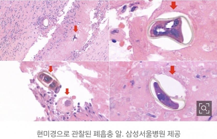 폐에 알을 깐 기생충…"민물 가재, 참게 생식 주의" (4)