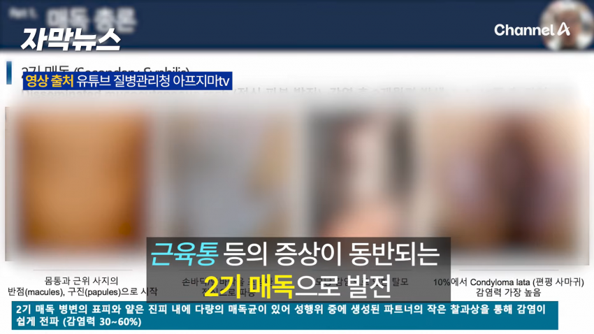 매독 감염자 확산, 한국 2030 남성 상당수(?) (15)