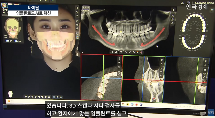 임플란트도 AI가 대세…수술 하루 만에 끝낸다 (6)