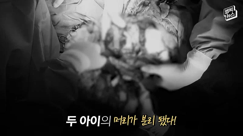 33시간 수술 끝에 얼굴 본 쌍둥이 (22)